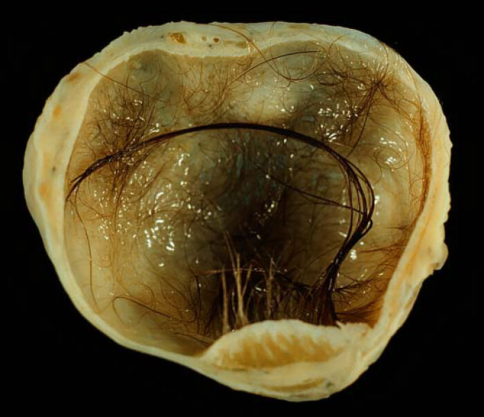 Inside a Teratoma