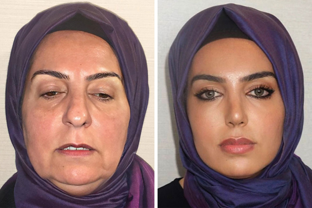 Before And After Photos From Turkish Plastic Surgery Clinic Have Left  People Baffled