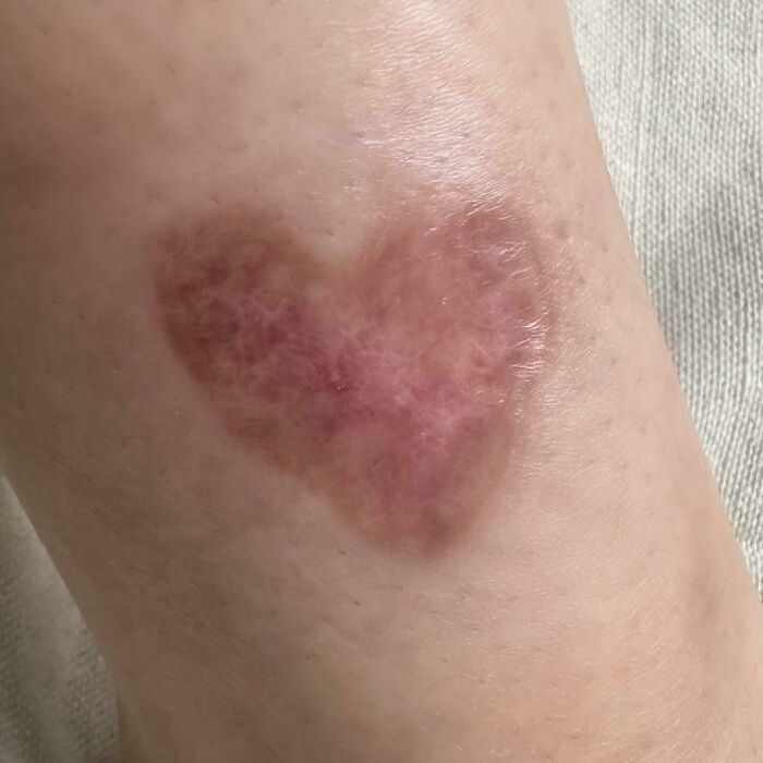 My Flesh-Eating Spider Bite Turned Into A Heart-Shaped Scar