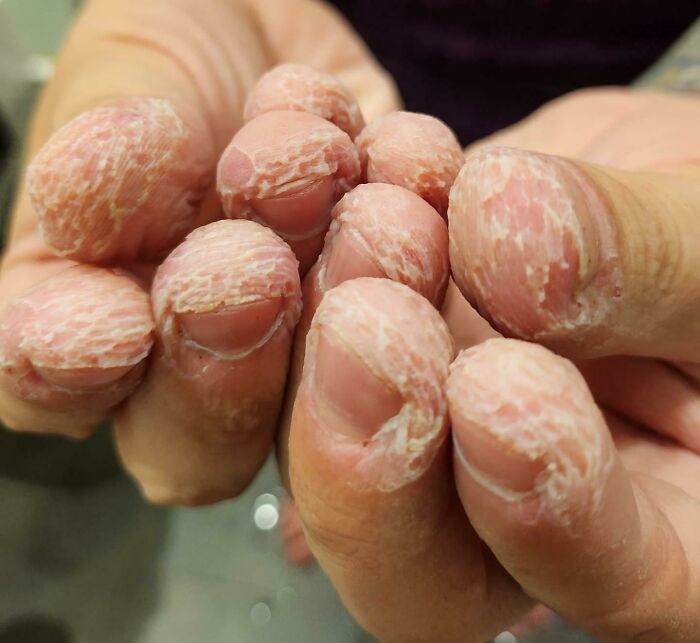 What My Fingers Look Like When I Get Out Of The Bath After Years Of Biting Them