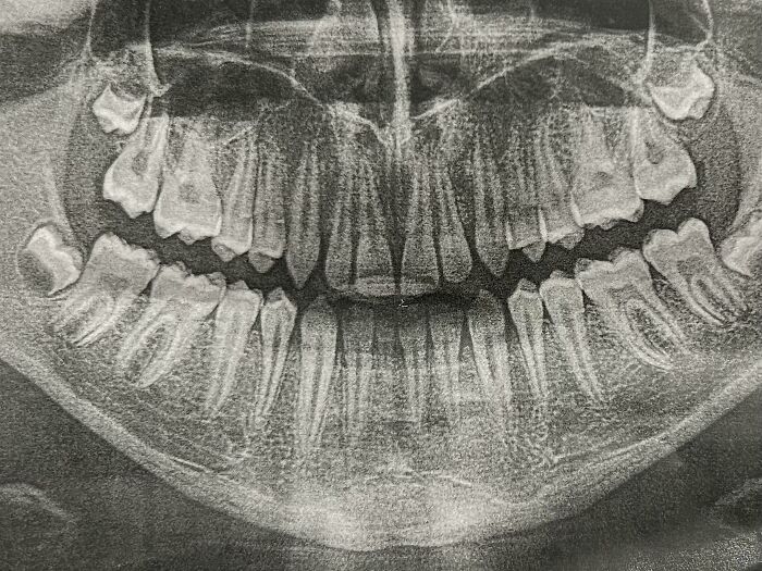 Here Is An X-Ray Of My Son Who Was Born Without An Adult Tooth And Still Has A Baby Tooth As A Teen