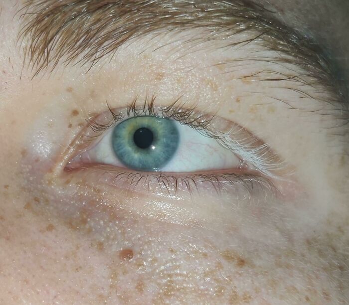 My Lashes Started Turning White On My Left Eye And The Skin Got Brighter Too. Pretty Sure It's Poliosis