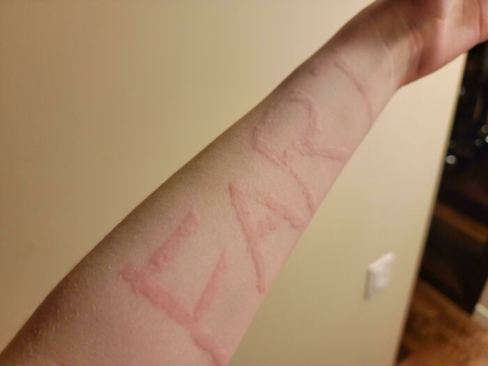 Dermatographism On My Arm. Lightly Scratching My Skin Results In A Raised, Itchy Wheal In The Shape Of Whatever I Scratch