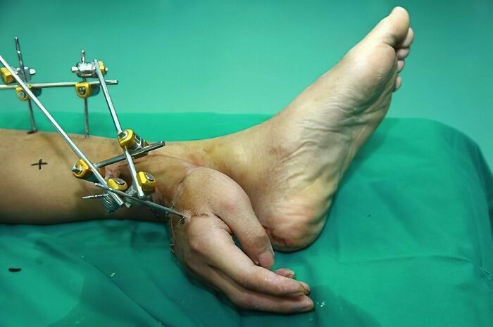 Doctors Kept Chinese Factory Worker Xie Wei's Hand Alive By Stitching It To Left Ankle