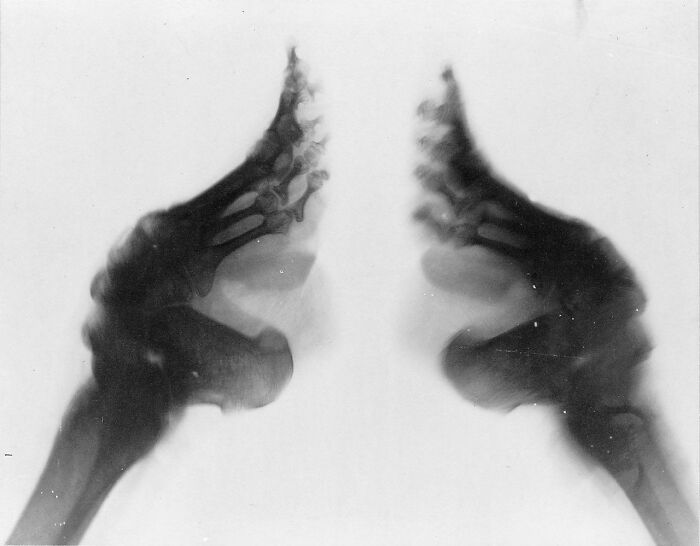 X-Ray Of A Chinese Woman Who Underwent Footbinding