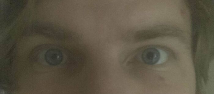My Eyes Started Doing A This Really Cool Looking - Different Sizes Thing. (Turns Out It’s A Tumour)