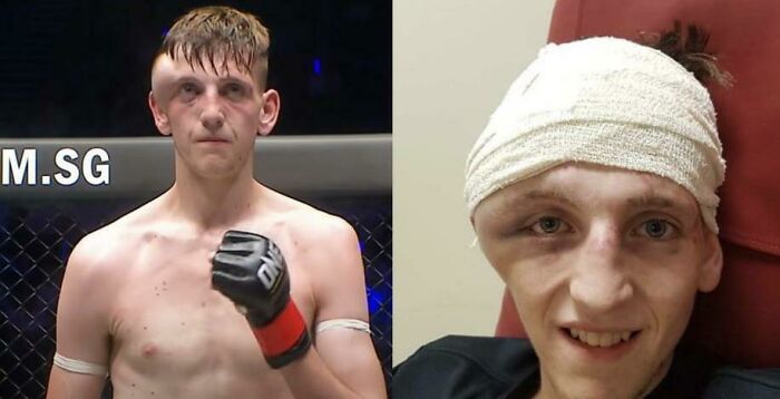 George Mann's Head After Receiving A Powerful Left Punch!