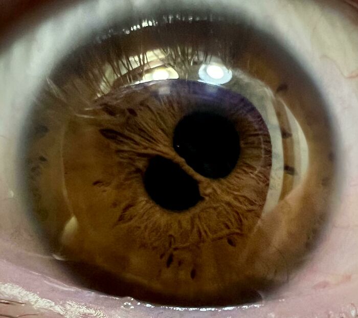 Persistent Pupillary Membrane Also Known As "Double Pupil"