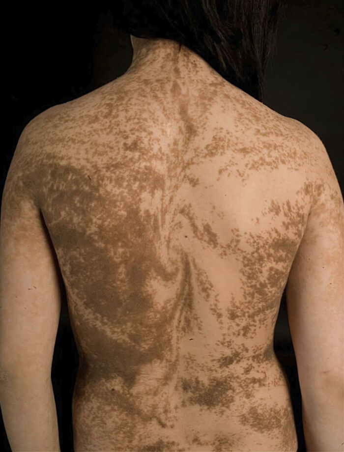 Humans Have Relics Of Growth As A Fetus, Representing Cell Division And Trails. They Are Invisible Under Normal Conditions But Can Become Apparent On The Skin Due To "Genetic Mosaicism"