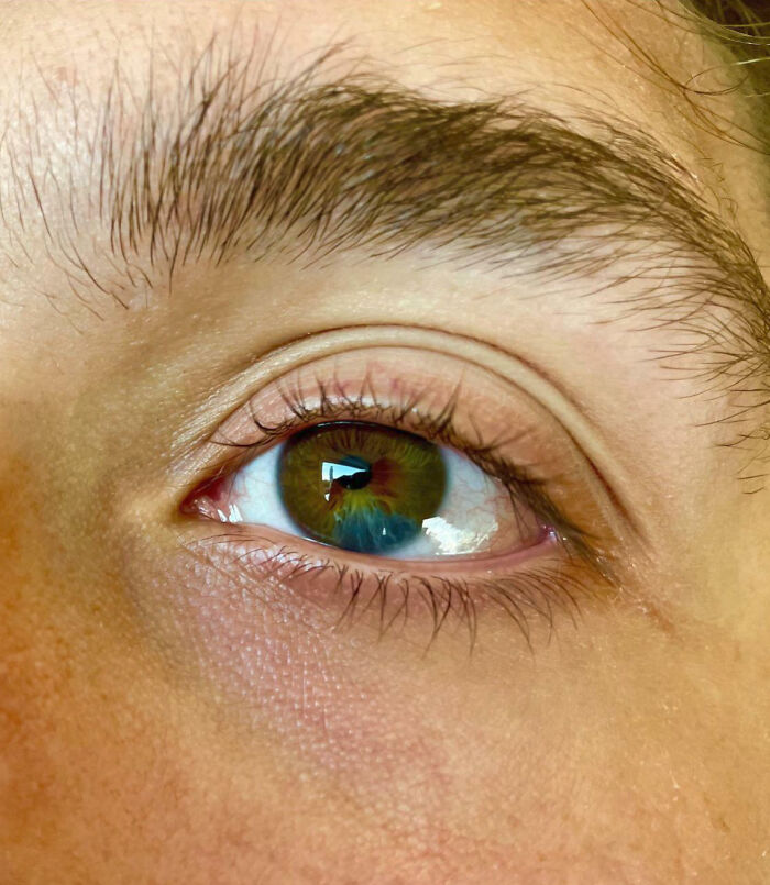 My Brother Was Born With Brown Eyes And A Slice Of Blue