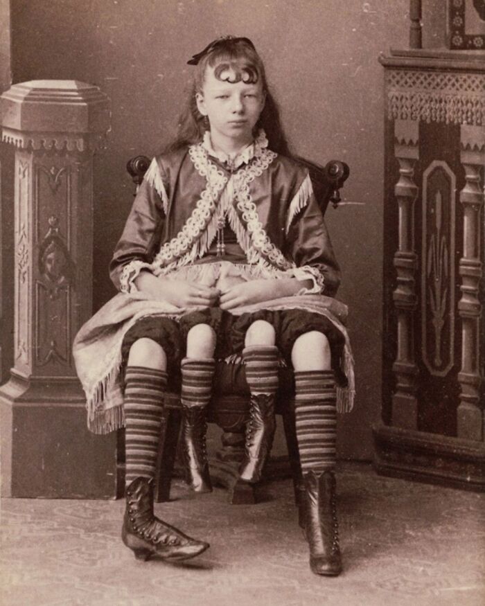 Myrtle Corbin, Known As The Four-Legged Girl From Texas, Was A Dipygus