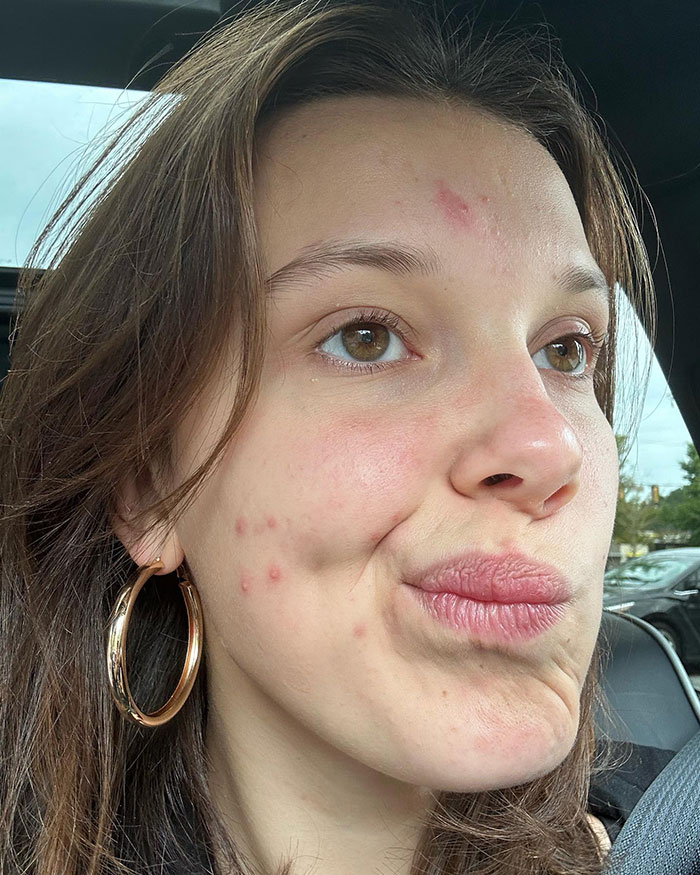 Stranger Things' Millie Bobby Brown Embraces Acne Breakout, And The Internet Is All Here For It
