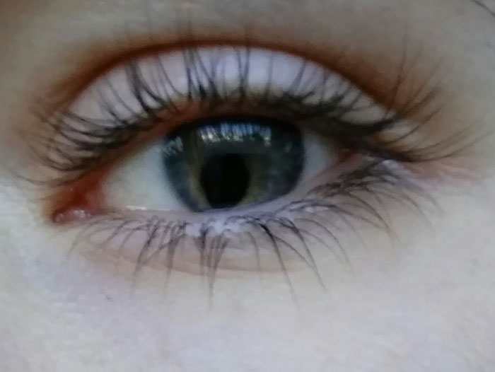 I Have A Coloboma Of The Iris