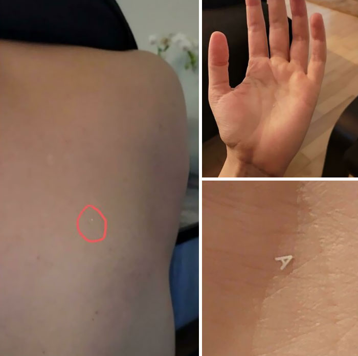 My Wife Found This Little Letter "A" On My Back