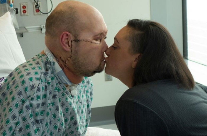 “I Don’t Want To Wear A Mask”: Veteran Who Lost Half Of His Face Receives Eyeball Transplant “I Don’t Want To Wear A Mask”: Veteran Who Lost Half Of His Face Receives Eyeball Transplant