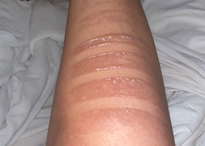 Fans Suffered From “Second-Degree Burns” At Taylor Swift’s Show Where Conditions Were “Inhumane” Fans Suffered From “Second-Degree Burns” At Taylor Swift’s Show Where Conditions Were “Inhumane”