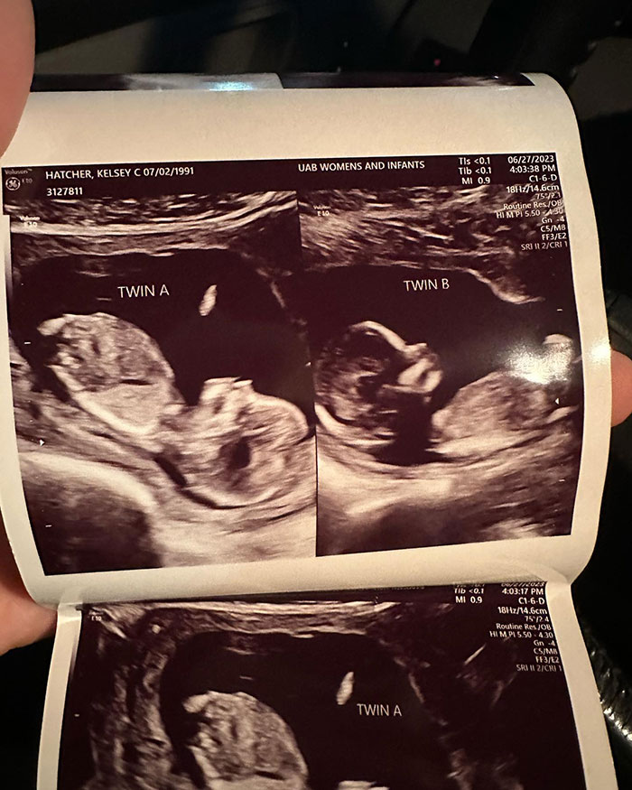 Woman With Double Uterus Is Expecting A Baby In Both, Twin Daughters Could Be Born Weeks Apart Woman With Double Uterus Is Expecting A Baby In Both, Twin Daughters Could Be Born Weeks Apart