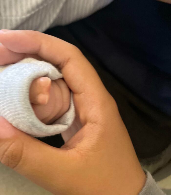 My Son Is Born With An Extra Thumb