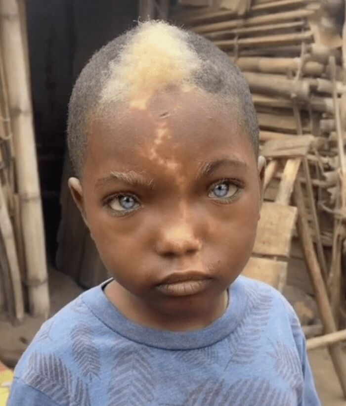 This Kid Was Born With Natural White Frontal Hairs, Blue Eyes And A Lightning-Like Mark Across His Face