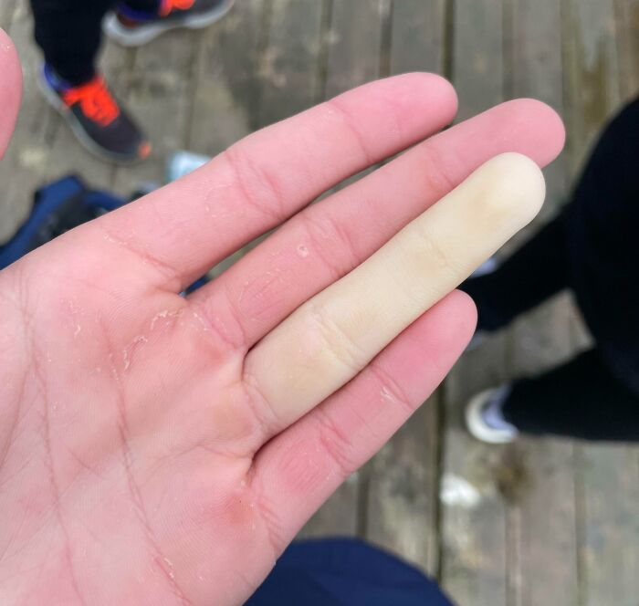 Finger Turned White After Staying Out In The Cold Rowing