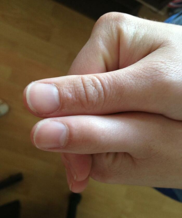 I Have No Knuckle In My Left Thumb. It's Smaller Than My Right As Muscles Have Not Built Up And I Have No Wrinkles At The Joint
