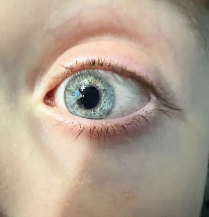 My Brother Has A Condition Where His Iris Leaks Into His Pupil (Doesn’t Effect His Vision)