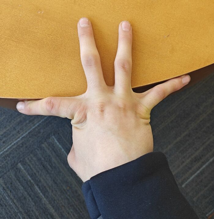 My Fingers Can Point 180° Opposite Each Other