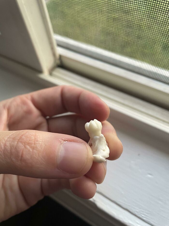 A Tooth That I Grew In My Abdomen