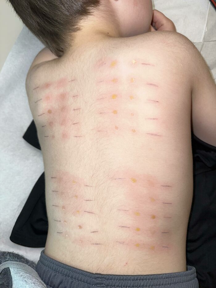 My Little Brother Took An Allergy Test And Was Positive For Every One