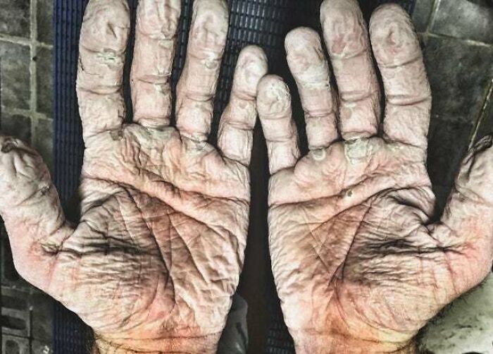 This Is What Two-Time Olympic Gold Medalist, Alex Gregory's Hands Looked Like After Rowing 600 Miles In The Arctic In 2017