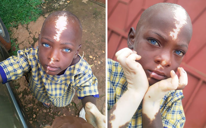Child With Waardenburg Syndrome