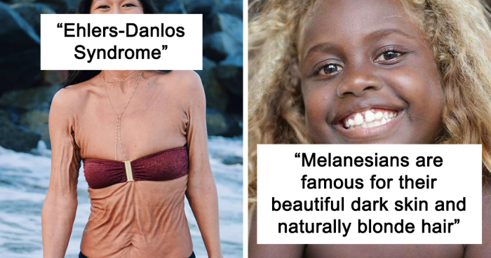50 Times Human Genetics Led To Some Unique Body Characteristics | Bored ...