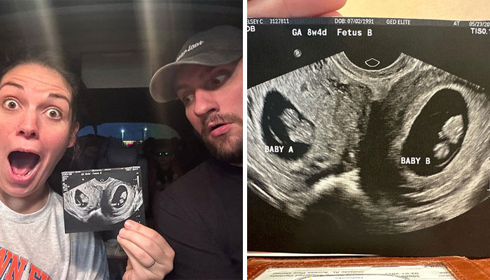 Woman With Double Uterus Is Expecting A Baby In Both, Twin Daughters Could Be Born Weeks Apart