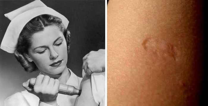 Smallpox Vaccination Scar ! Who Has One?