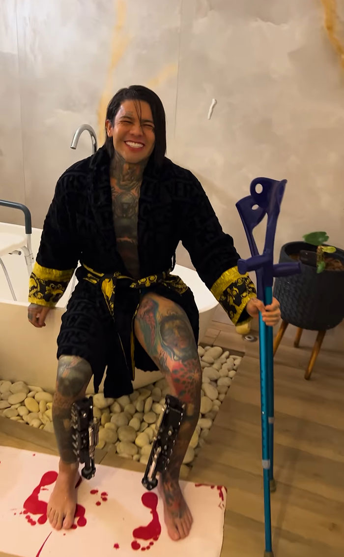 Influencer Spends $175,000 On “Most Painful” Leg-Lengthening Surgery To Grow Six Inches Influencer Spends $175,000 On “Most Painful” Leg-Lengthening Surgery To Grow Six Inches