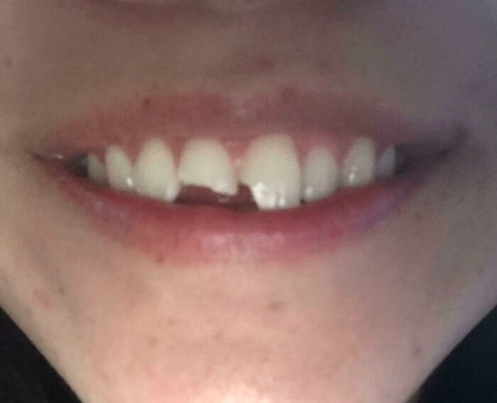 Chipped My Teeth 30 Minutes Into The New Year. Still Smiling Tho. Unfortunate Thing Is No Dentist Till The 2nd