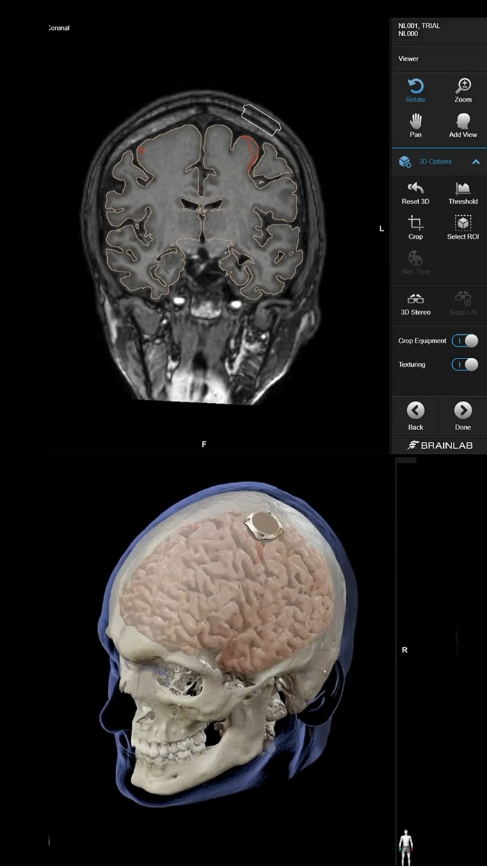 “That Is The Goal”: Elon Musk’s Neuralink Is Implanted In First-Ever Human