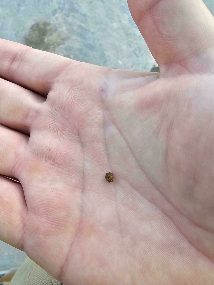 Passing A Kidneystone On My First Day Of Work In The Bathroom Before Our Safety Meeting Where I Had To Meet Everyone. 4mm Stone Passed After 5 Weeks From First Sign