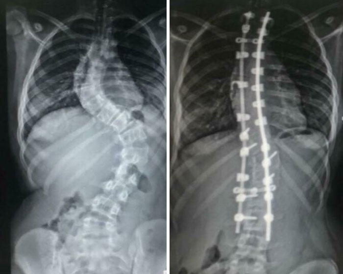 Mi columna antes y después de la operación