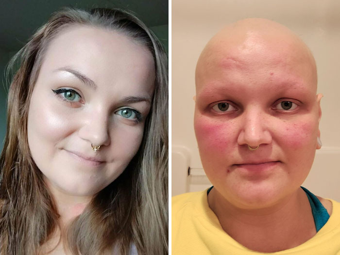 Before And After From Chemo. I Was Diagnosed In June