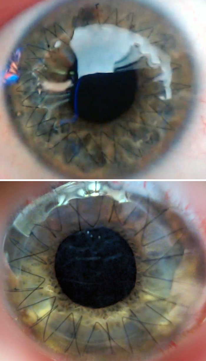 The Difference Between The Stitches In My Eyes From My First And Second Corneal Transplants