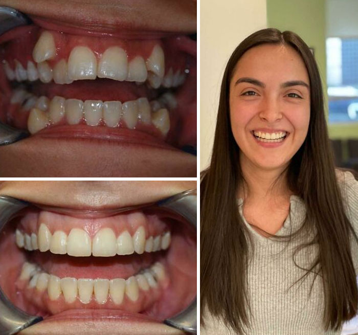 Antes y después de la ortodoncia
