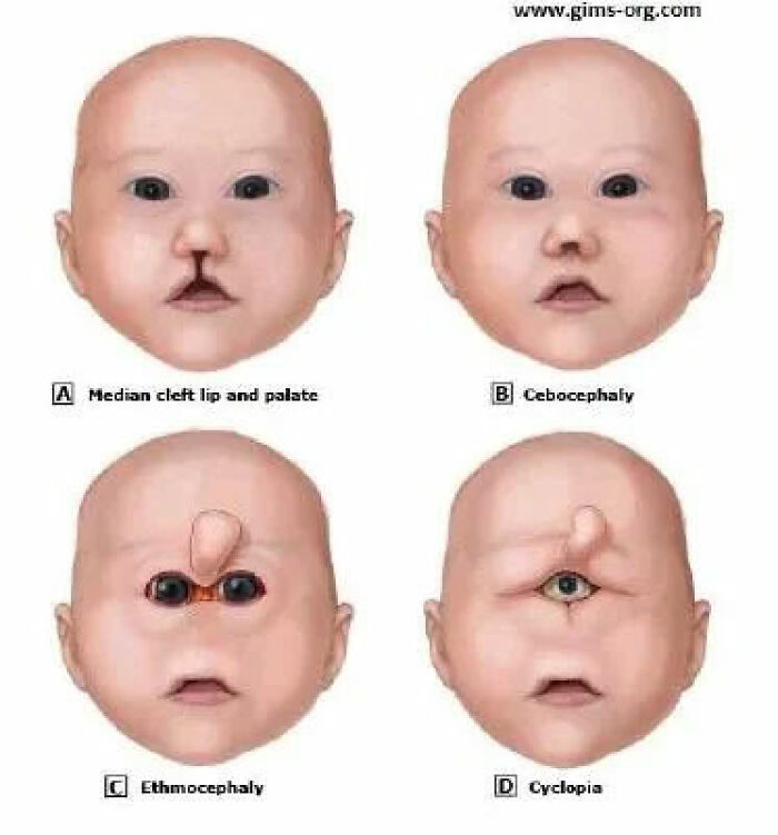 Holoprosencephaly - A Condition Which Causes Hideous Birth Defects - Is Usually Caused By A Mutation In Sonic The Hedgehog Gene (Yes, That's Its Scientific Name)