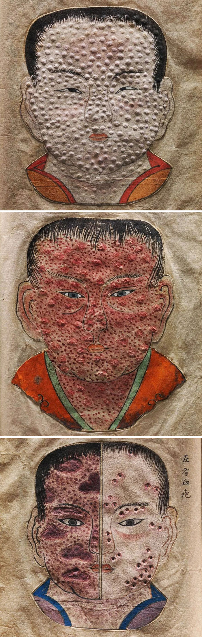 Amazing Illustrations From A C.1720 Japanese Medical Book On Smallpox, Which Cleverly Uses Paper Embossing To Show The Changing Texture Of Smallpox Lesions During Different Stages Of The Disease
