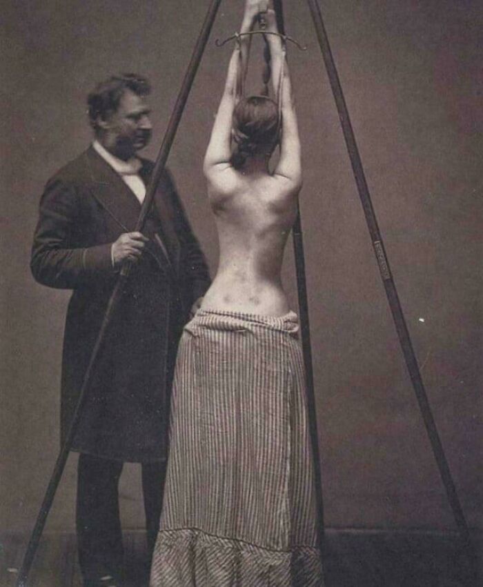 Dr. Lewis Sayre Treating Scoliosis, Checking The Curvature Of The Spine - 1870s