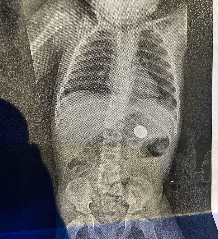 On Valentine's Day, My Son Decided To Show Me His First Magic Trick: How To Make A Coin Disappear. One X-Ray Later, I Found It   