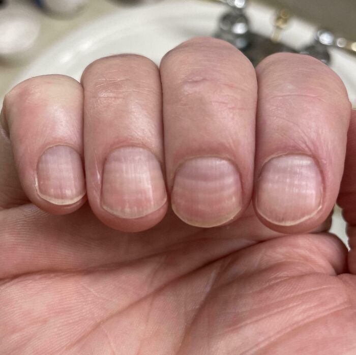 6 Lines On My Fingernails, One For Each Chemo Session I Had Recently