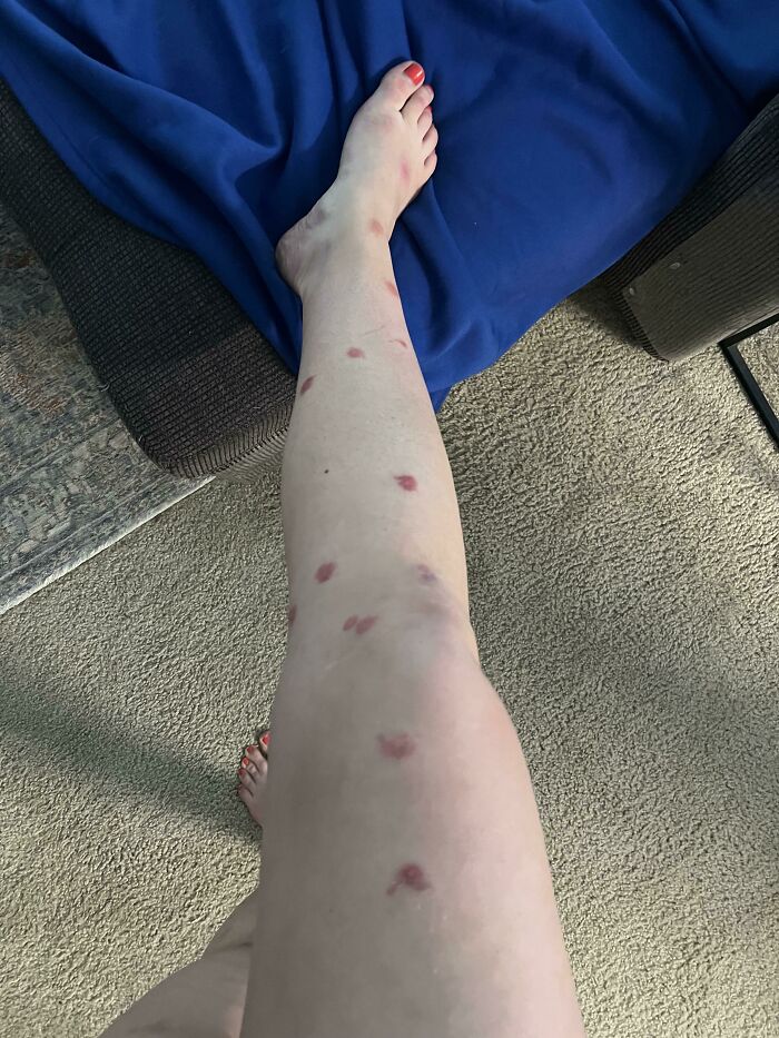 Al parecer soy alérgica a los mosquitos, por si no eran ya lo bastante molestos