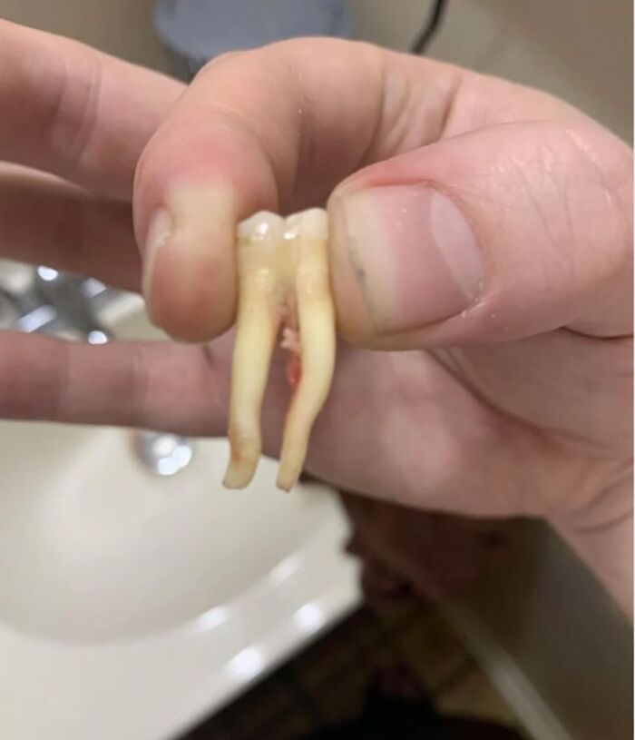 Las raíces de mi diente