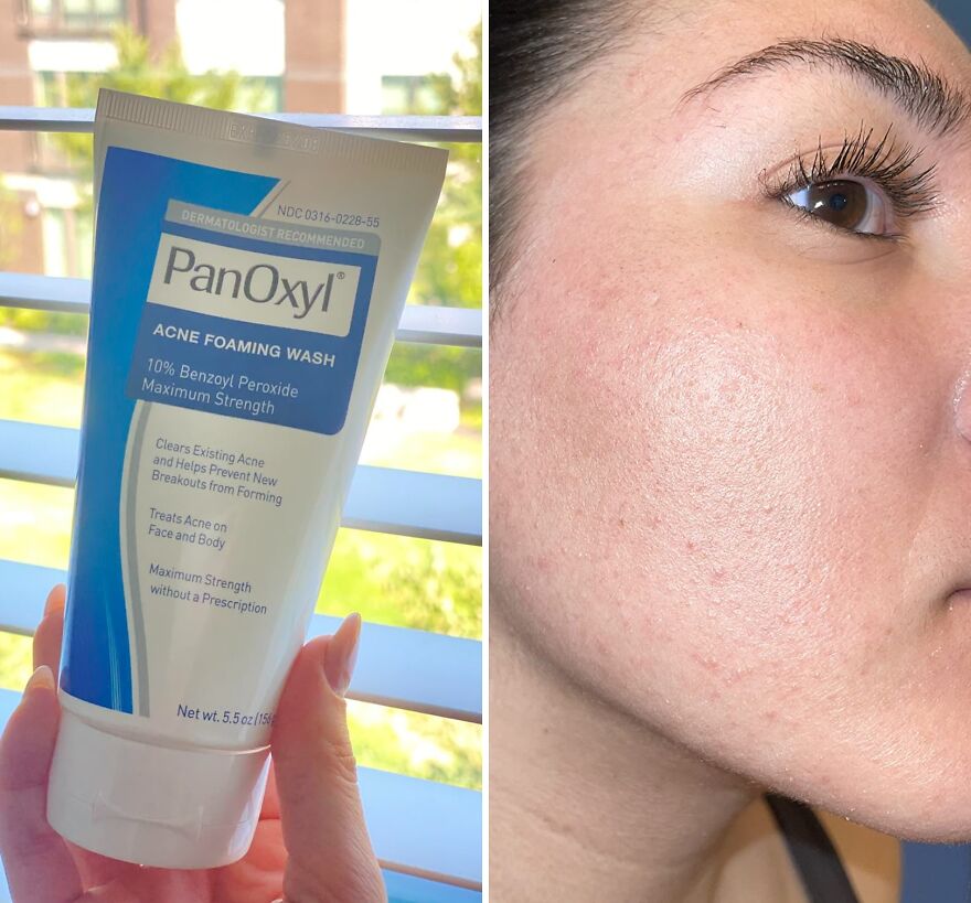 Clear Skin Essential: Panoxyl 10% Benzoyl Peroxide Foaming Wash 
